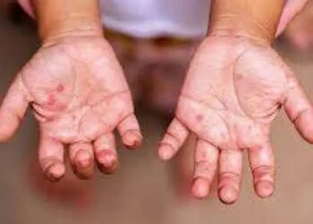 آخر أخبار مدرسة الألسن الدولية ورصد إصابات فيروس HFMD