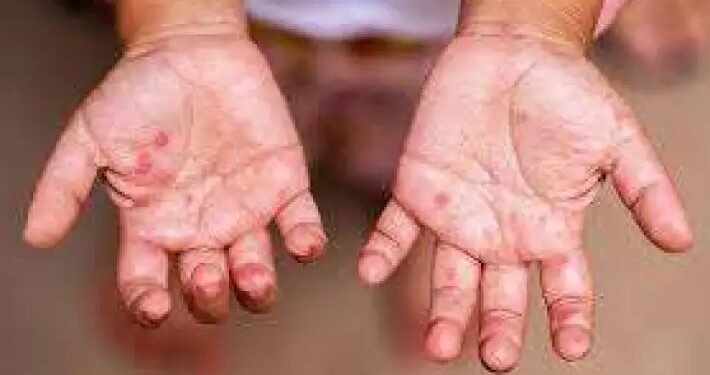 آخر أخبار مدرسة الألسن الدولية ورصد إصابات فيروس HFMD